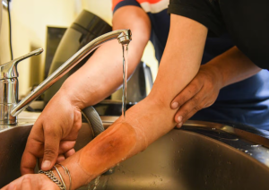 Formation premiers secours : la brûlure